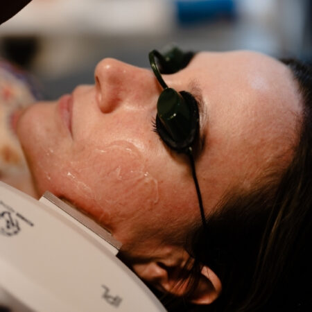 Close-up of woman wearing protective eyewear during IPL photofacial with treatment gel on her cheek