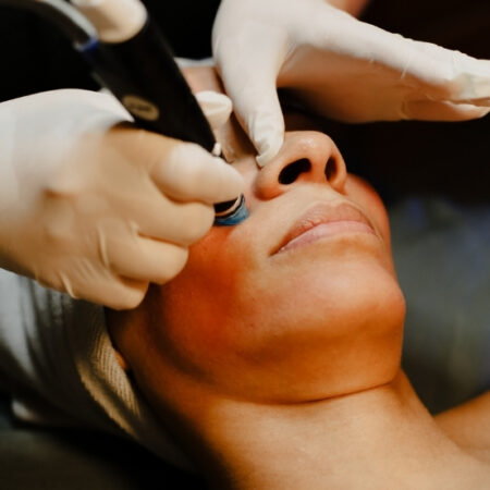 Esthetician performing Hydrafacial on guest's cheek using blue-tipped device and gloves.