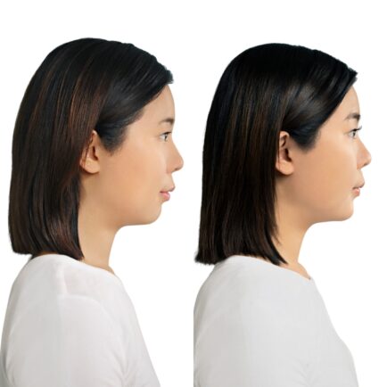 Restylane Contour Chin Filler at Natural Body Spa + Med Spa Atlanta 434x434