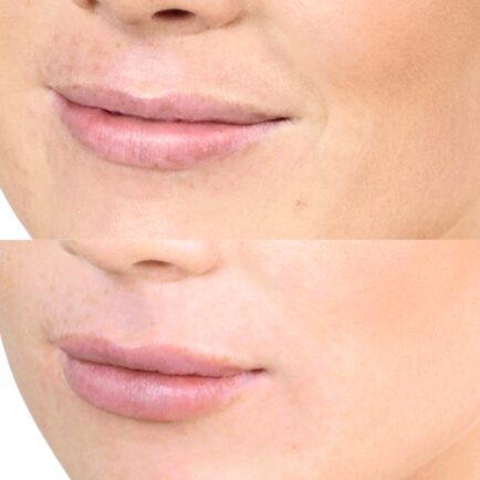 Restylane Kysse Lip Filler at Natural Body Spa + Med Spa Atlanta 434x434