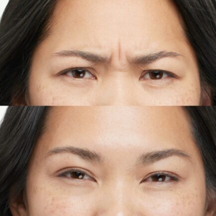 Botox Before and After 30 Days Post Treatment at Natural Body Spa + Med Spa Atlanta 434x434