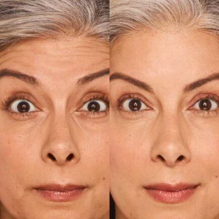 Botox Before and After 30 Days Post Treatment at Natural Body Spa + Med Spa Atlanta 434x434