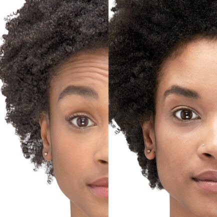 Botox Before and After 30 Days Post Treatment at Natural Body Spa + Med Spa Atlanta 434x434