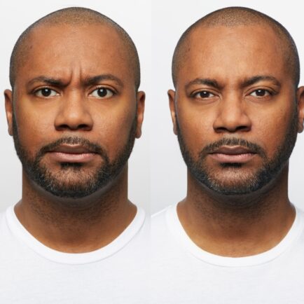 Dysport at Natural Body Spa + Med Spa Atlanta 434x434