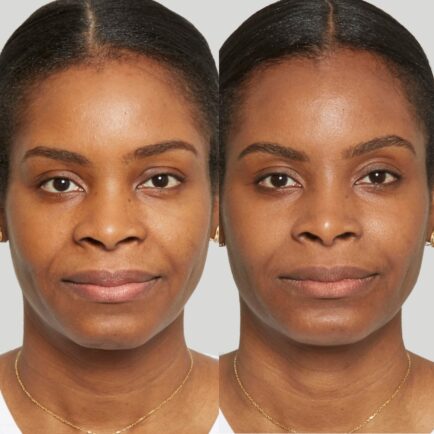 Sculptra Before and After 6 Months at Natural Body Spa + Med Spa Atlanta 434x434