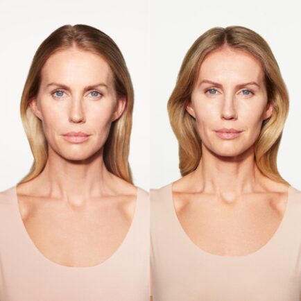 Sculptra Before and After 6 Months at Natural Body Spa + Med Spa Atlanta 434x434