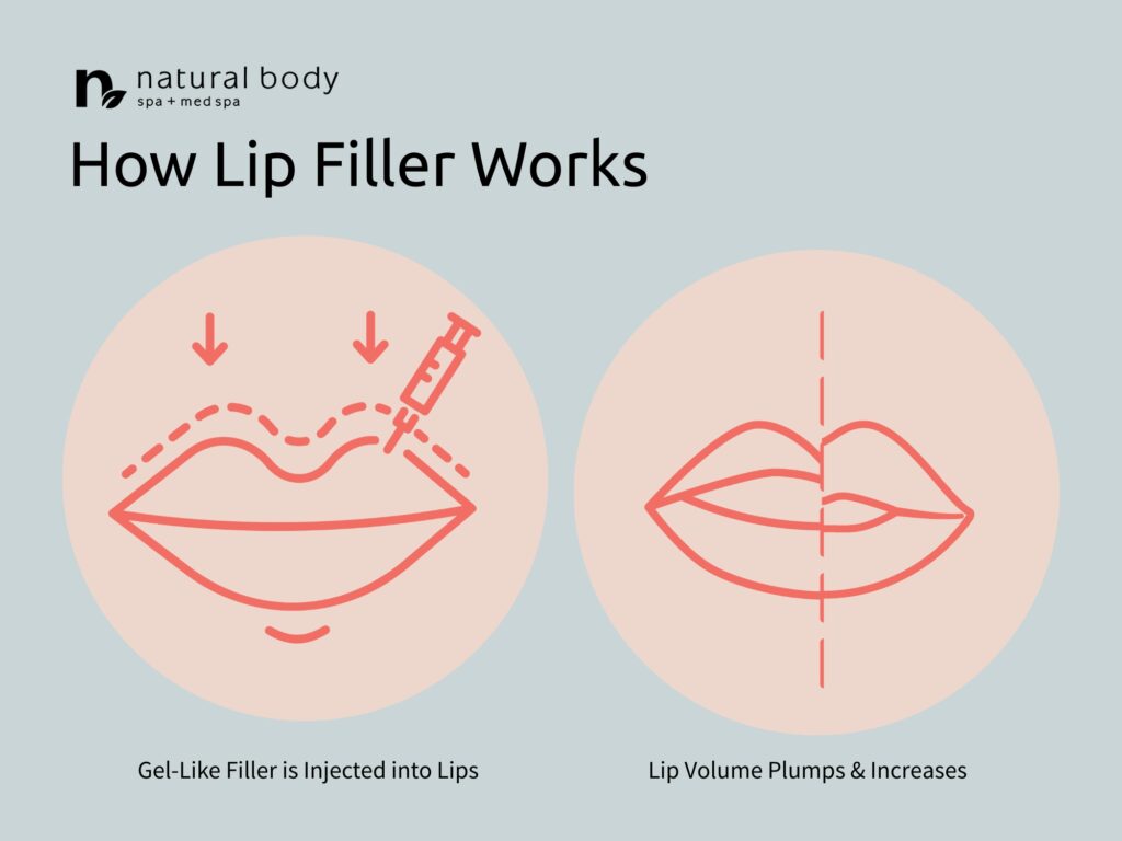 How lip filler works graphic by Natural Body Spa + Med Spa in Atlanta, GA
