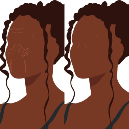 Erbium Skin Resurfacing Before and After Illustraion