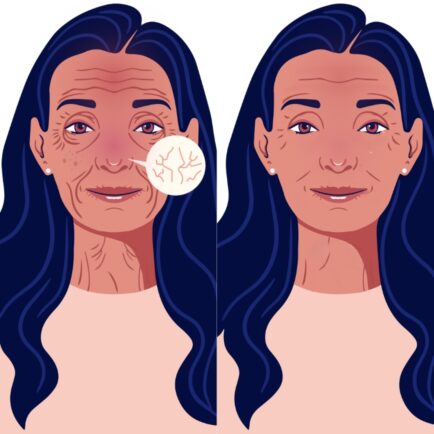 IPL Photofacial before and after at Natural Body Spa + Med Spa in Atlanta, GA