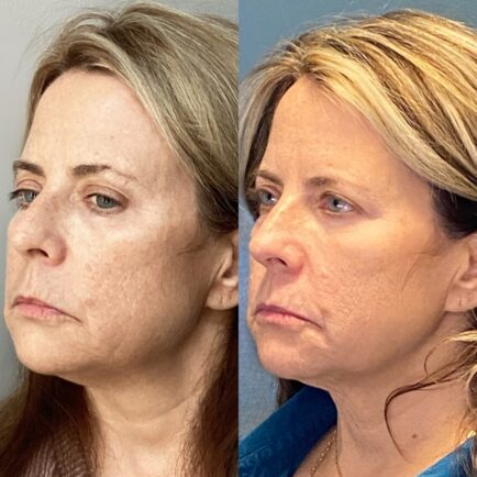Before and After Pixel8 RF microneedling at Natural Body Spa + Med Spa in Atlanta, GA