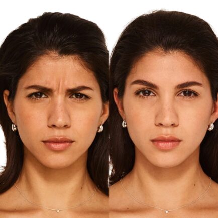 Botox Before and After - Natural Body Spa + Med Spa in Atlanta
