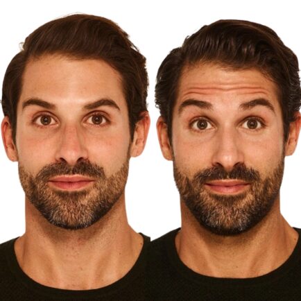 Botox Before and After - Natural Body Spa + Med Spa in Atlanta