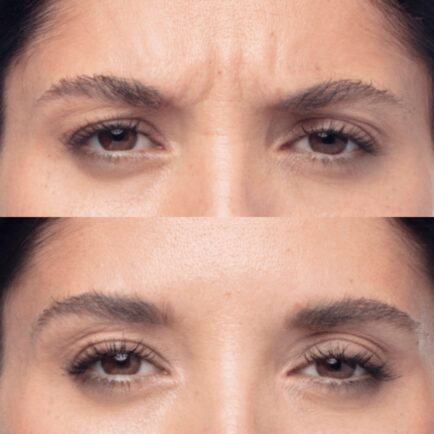 Dysport at Natural Body Spa + Med Spa Atlanta 434x434