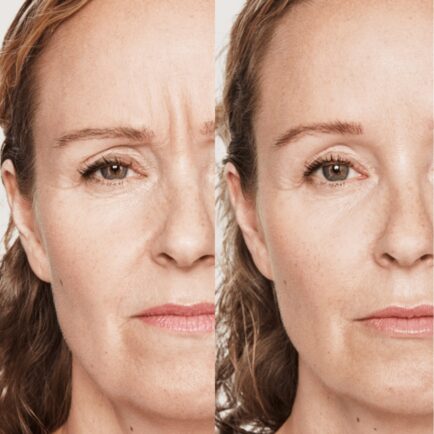 Dysport at Natural Body Spa + Med Spa Atlanta 434x434