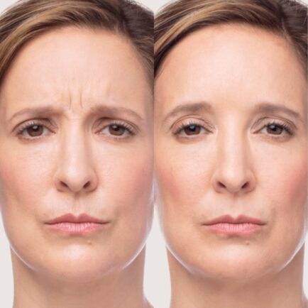 Dysport Before and After - Natural Body Spa + Med Spa in Atlanta