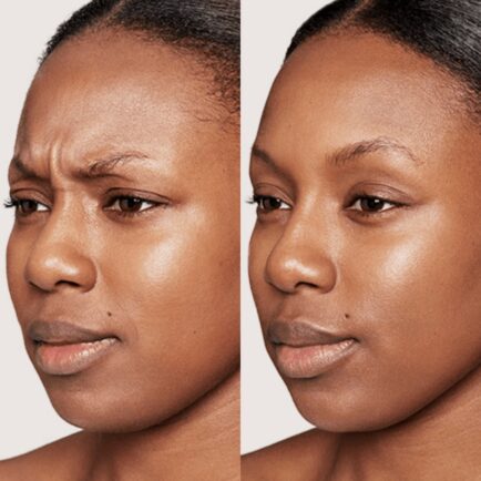 Dysport Before and After - Natural Body Spa + Med Spa in Atlanta