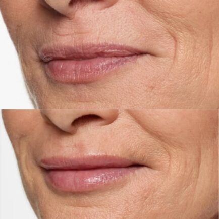 Restylane Silk Lip Filler Before and After