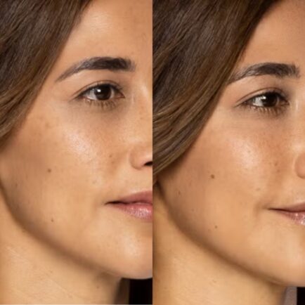 Restylane Contour Filler Before and After