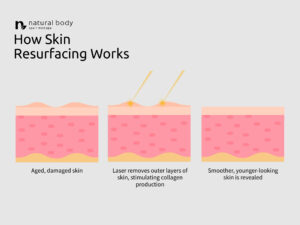 How Erbium Skin Resurfacing Works Diagram at Natural Body Spa + Med Spa in Atlanta