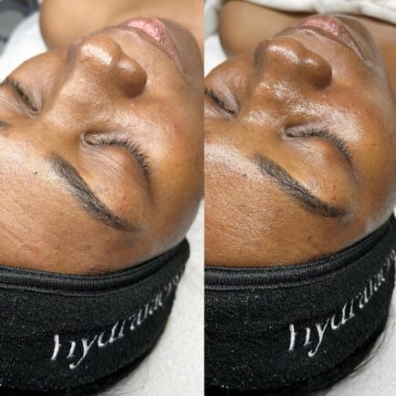 hydrafacial_beforeandafter_africanamericanskin