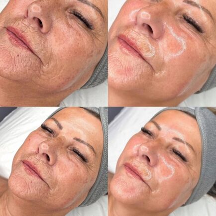 hydrafacial_beforeandafter_agingskin
