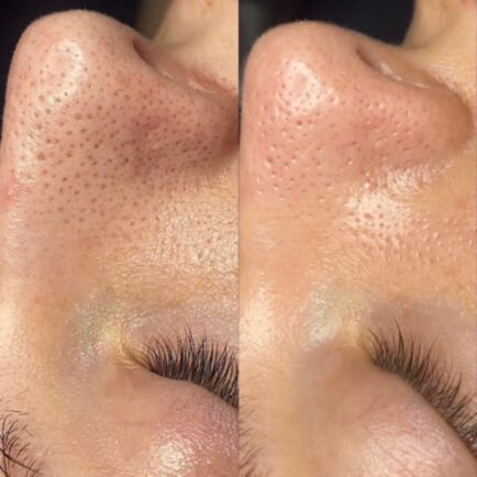 hydrafacial_beforeandafter_blackheads