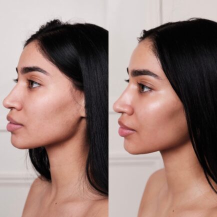 hydrafacial_beforeandafter_dullness