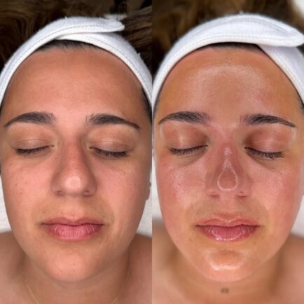 hydrafacial_beforeandafter_hydratedskin