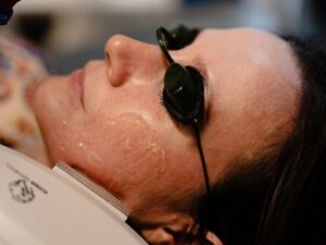 Woman receiving an IPL photofacial at Natural Body Spa + Med Spa in Atlanta