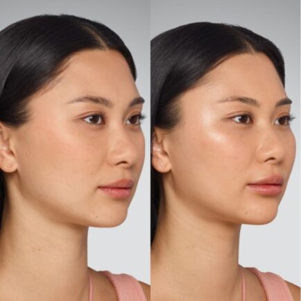 Juvederm Cheek, Undereye, Chin, and Lip Filler Before and After