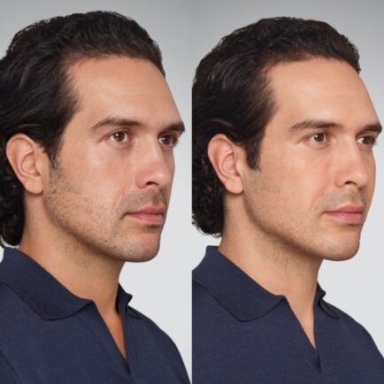 Juvederm Cheek, Undereye, Chin, and Lip Filler Before and After