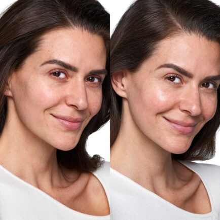 Skinvive By Juvederm Before and After at Natural Body Spa + Med Spa Atlanta