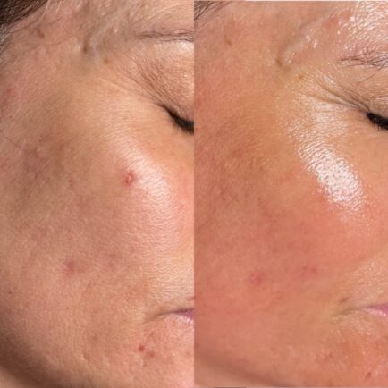SkinPen Microneedling Before and After - Natural Body Spa + Med Spa in Atlanta