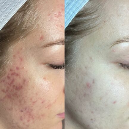 SkinPen Microneedling Before and After - Natural Body Spa + Med Spa in Atlanta
