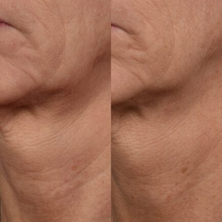 SkinPen Microneedling Before and After - Natural Body Spa + Med Spa in Atlanta