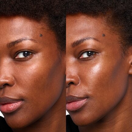 Skinvive By Juvederm Before and After at Natural Body Spa + Med Spa Atlanta