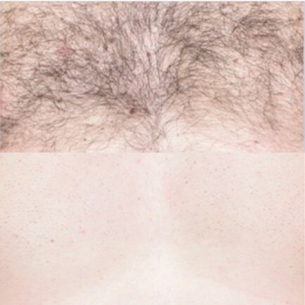 Before and After of Laser Hair Removal Treatment using Spectrum Laser at Natural Body Spa + Med Spa in Atlanta, GA