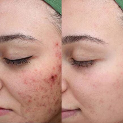 Chemical Peel VI-Peel 2 Treatments Before and After at Natural Body Spa + Med Spa in Atlanta 434x434